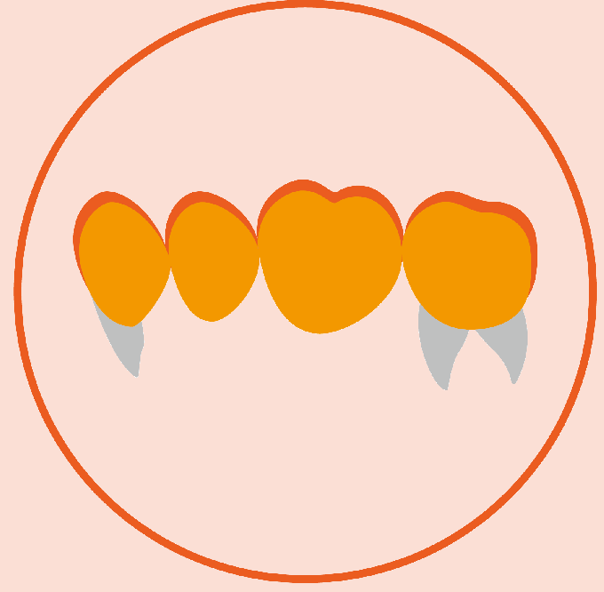 Reduced Posterior Bridge(â¥4 units)